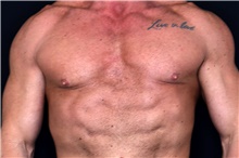 Male Breast Reduction Before Photo by Landon Pryor, MD, FACS; Rockford, IL - Case 47548