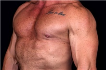 Male Breast Reduction After Photo by Landon Pryor, MD, FACS; Rockford, IL - Case 47548