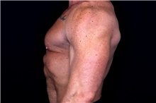 Male Breast Reduction Before Photo by Landon Pryor, MD, FACS; Rockford, IL - Case 47548