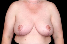 Breast Reduction After Photo by Landon Pryor, MD, FACS; Rockford, IL - Case 47550