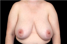 Breast Reduction Before Photo by Landon Pryor, MD, FACS; Rockford, IL - Case 47550