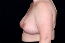 Breast Reduction After Photo by Landon Pryor, MD, FACS; Rockford, IL - Case 47550