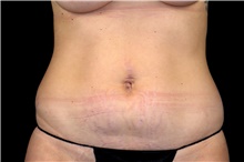 Liposuction Before Photo by Landon Pryor, MD, FACS; Rockford, IL - Case 47551