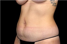 Liposuction Before Photo by Landon Pryor, MD, FACS; Rockford, IL - Case 47551