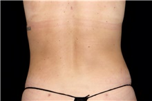 Liposuction After Photo by Landon Pryor, MD, FACS; Rockford, IL - Case 47551