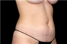 Liposuction After Photo by Landon Pryor, MD, FACS; Rockford, IL - Case 47551
