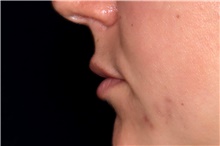 Dermal Fillers Before Photo by Landon Pryor, MD, FACS; Rockford, IL - Case 47552