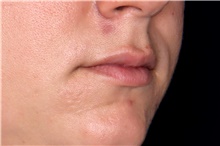 Dermal Fillers Before Photo by Landon Pryor, MD, FACS; Rockford, IL - Case 47552