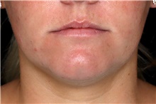 Dermal Fillers Before Photo by Landon Pryor, MD, FACS; Rockford, IL - Case 47553