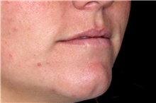 Dermal Fillers Before Photo by Landon Pryor, MD, FACS; Rockford, IL - Case 47553