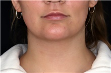 Injectable Fillers After Photo by Landon Pryor, MD, FACS; Rockford, IL - Case 47554