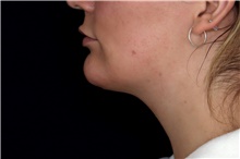 Injectable Fillers After Photo by Landon Pryor, MD, FACS; Rockford, IL - Case 47554