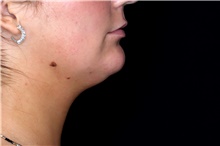 Injectable Fillers Before Photo by Landon Pryor, MD, FACS; Rockford, IL - Case 47554
