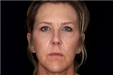 Eyelid Surgery After Photo by Landon Pryor, MD, FACS; Rockford, IL - Case 47555