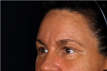 Injectable Fillers After Photo by Landon Pryor, MD, FACS; Rockford, IL - Case 47556