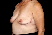 Breast Implant Removal After Photo by Landon Pryor, MD, FACS; Rockford, IL - Case 47557