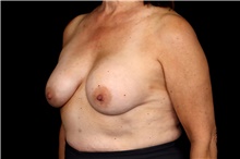 Breast Implant Removal Before Photo by Landon Pryor, MD, FACS; Rockford, IL - Case 47557