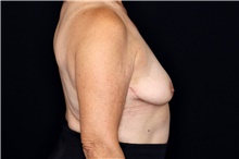 Breast Implant Removal After Photo by Landon Pryor, MD, FACS; Rockford, IL - Case 47557