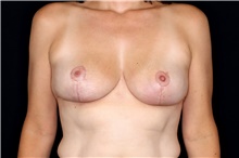 Breast Reduction After Photo by Landon Pryor, MD, FACS; Rockford, IL - Case 47558