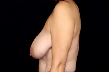 Breast Reduction Before Photo by Landon Pryor, MD, FACS; Rockford, IL - Case 47558