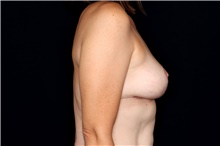 Breast Reduction After Photo by Landon Pryor, MD, FACS; Rockford, IL - Case 47558