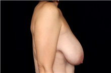 Breast Reduction Before Photo by Landon Pryor, MD, FACS; Rockford, IL - Case 47558
