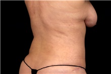 Tummy Tuck After Photo by Landon Pryor, MD, FACS; Rockford, IL - Case 47561