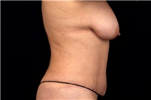 Tummy Tuck After Photo by Landon Pryor, MD, FACS; Rockford, IL - Case 47561