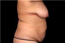 Tummy Tuck Before Photo by Landon Pryor, MD, FACS; Rockford, IL - Case 47561