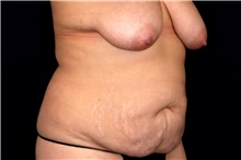 Tummy Tuck Before Photo by Landon Pryor, MD, FACS; Rockford, IL - Case 47561