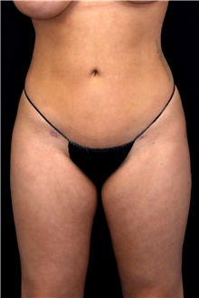 Body Contouring After Photo by Landon Pryor, MD, FACS; Rockford, IL - Case 47563