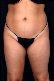 Body Contouring Before Photo by Landon Pryor, MD, FACS; Rockford, IL - Case 47563