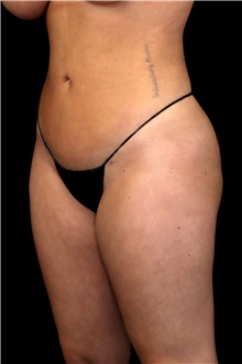 Body Contouring After Photo by Landon Pryor, MD, FACS; Rockford, IL - Case 47563