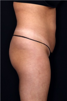 Body Contouring Before Photo by Landon Pryor, MD, FACS; Rockford, IL - Case 47563
