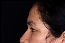 Eyelid Surgery Before Photo by Landon Pryor, MD, FACS; Rockford, IL - Case 47601