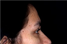 Eyelid Surgery After Photo by Landon Pryor, MD, FACS; Rockford, IL - Case 47601