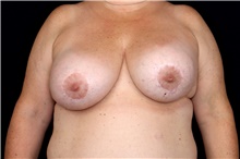 Breast Implant Removal Before Photo by Landon Pryor, MD, FACS; Rockford, IL - Case 47602