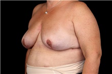 Breast Implant Removal After Photo by Landon Pryor, MD, FACS; Rockford, IL - Case 47602