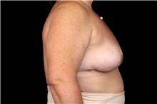 Breast Implant Removal After Photo by Landon Pryor, MD, FACS; Rockford, IL - Case 47602