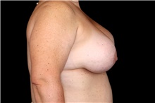 Breast Implant Removal Before Photo by Landon Pryor, MD, FACS; Rockford, IL - Case 47602