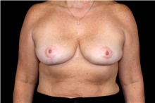 Breast Implant Removal After Photo by Landon Pryor, MD, FACS; Rockford, IL - Case 47603