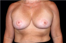 Breast Implant Removal Before Photo by Landon Pryor, MD, FACS; Rockford, IL - Case 47603