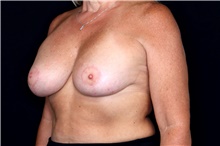 Breast Implant Removal Before Photo by Landon Pryor, MD, FACS; Rockford, IL - Case 47603