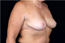 Breast Implant Removal After Photo by Landon Pryor, MD, FACS; Rockford, IL - Case 47603