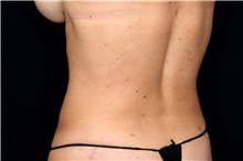 Liposuction After Photo by Landon Pryor, MD, FACS; Rockford, IL - Case 47623