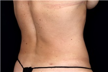 Liposuction After Photo by Landon Pryor, MD, FACS; Rockford, IL - Case 47623