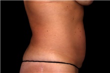 Liposuction Before Photo by Landon Pryor, MD, FACS; Rockford, IL - Case 47623