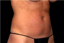 Liposuction Before Photo by Landon Pryor, MD, FACS; Rockford, IL - Case 47623