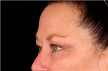 Eyelid Surgery Before Photo by Landon Pryor, MD, FACS; Rockford, IL - Case 47624