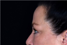 Eyelid Surgery After Photo by Landon Pryor, MD, FACS; Rockford, IL - Case 47624